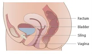 Mid-uretheral sling system